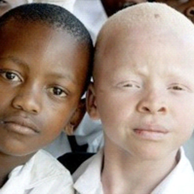 альбинизм у ребёнка с негроидным происхождением